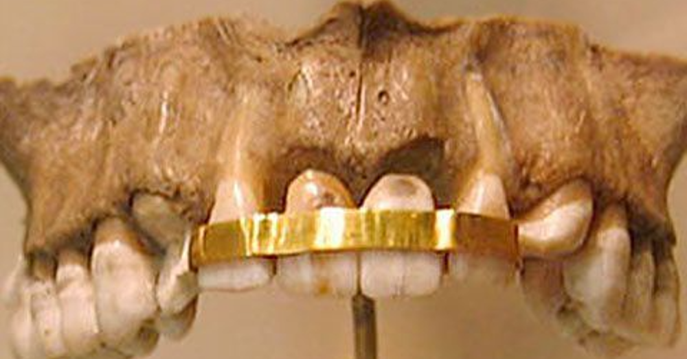 The History of Braces